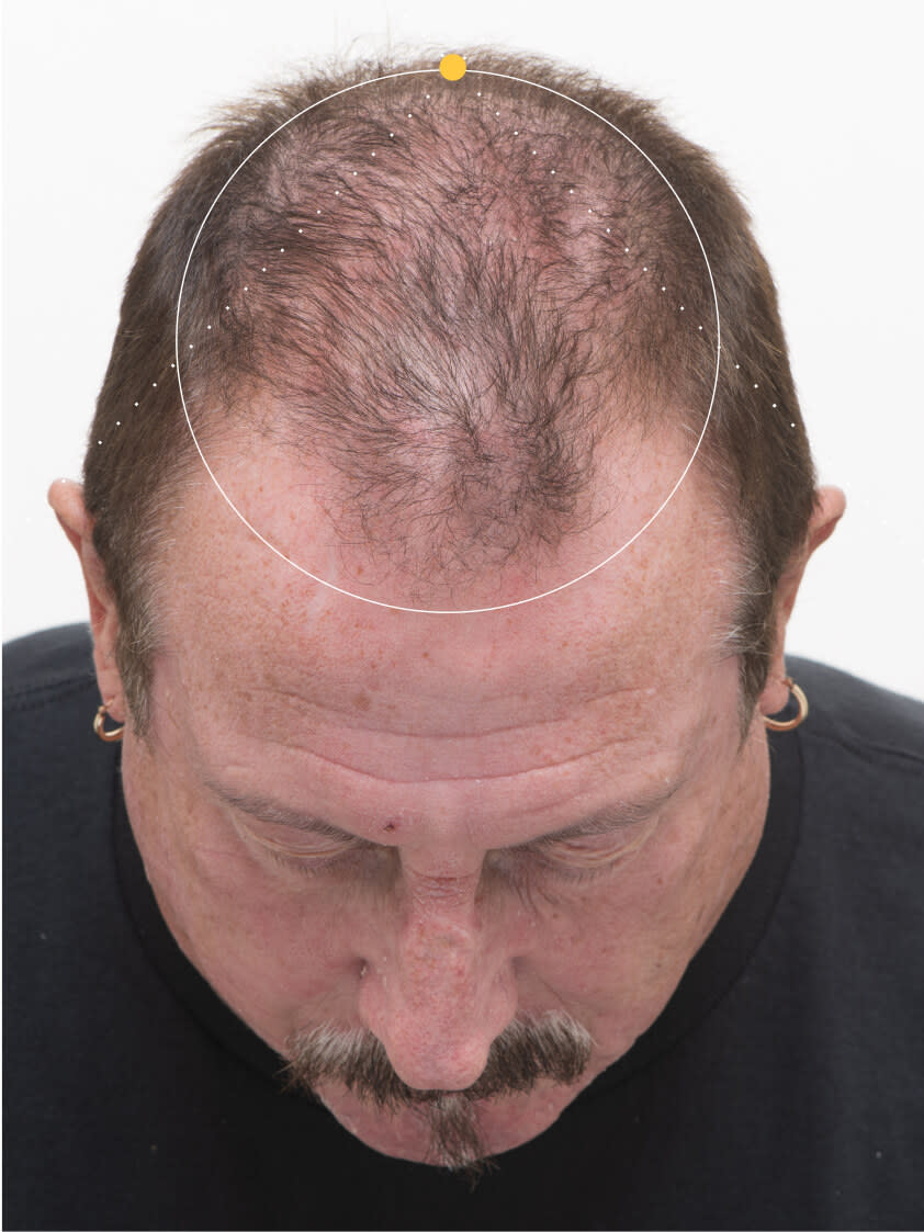 Gordon before taking nutrafol men 50+ hair growth nutraceutical.