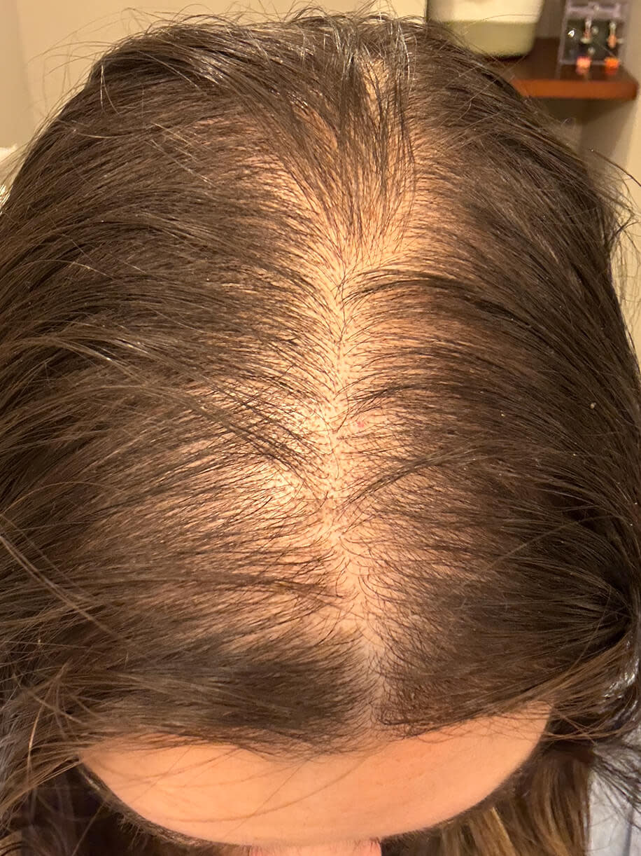 Antonella before taking Nutrafol Women’s Postpartum Hair Growth Nutraceutical.