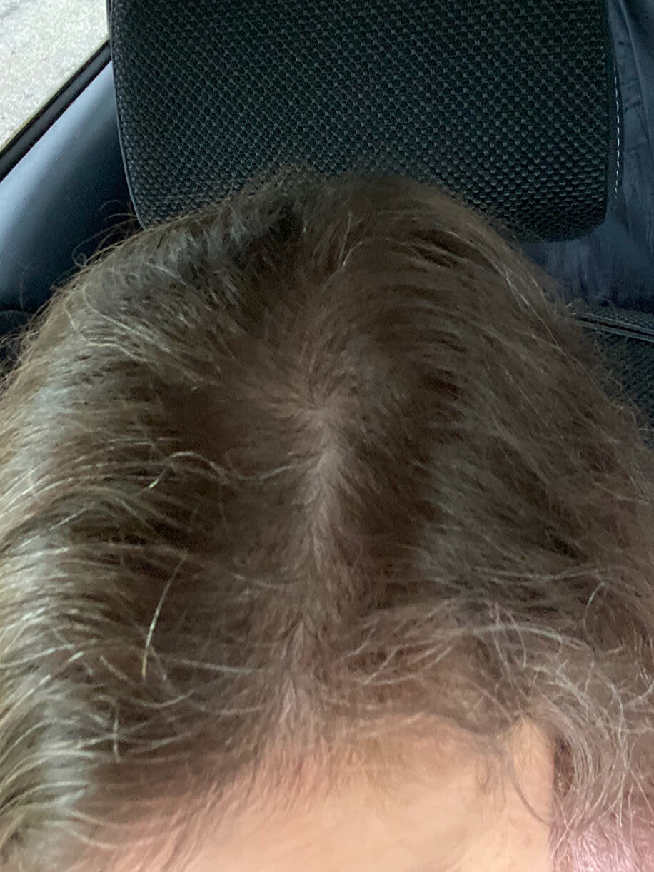 Jodi 7 months into taking Nutrafol Women’s Balance Hair Growth Nutraceutical. Results are from a clinical study and may vary