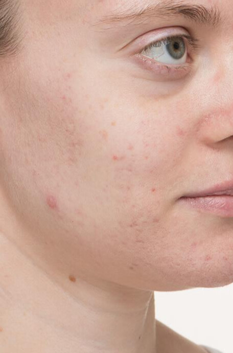 Maryann before taking Nutrafol Clear Skin Nutraceutical.