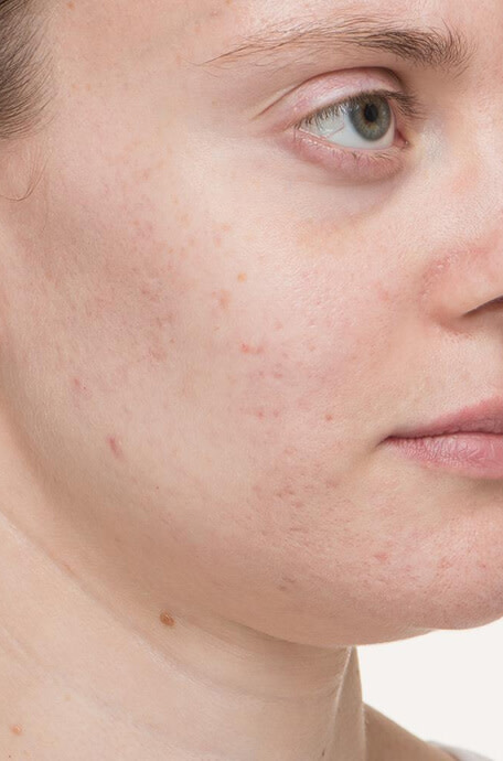 Maryann after 4 weeks taking Nutrafol Clear Skin Nutraceutical.