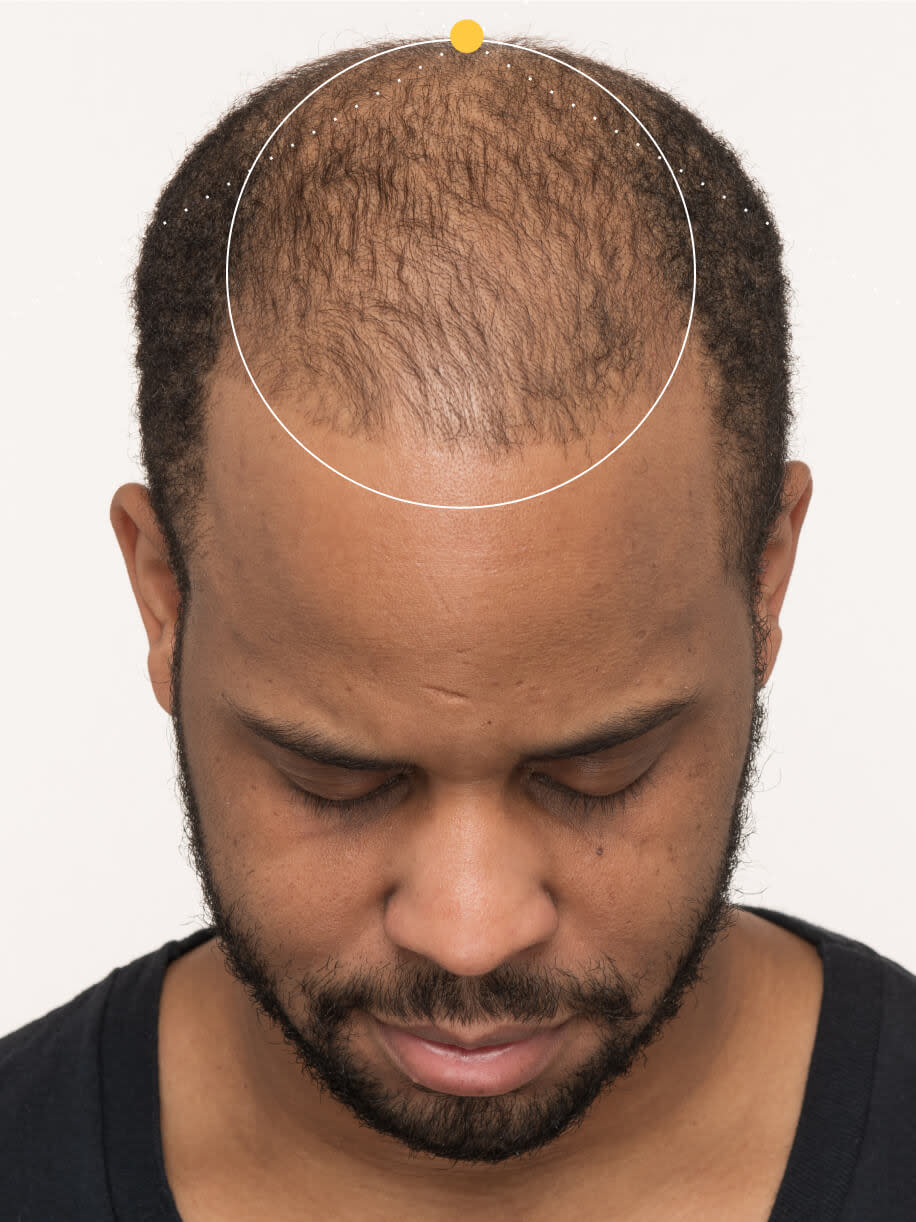 Adrian 3 months into taking Nutrafol Men Hair Growth Nutraceutical. Results are from a clinical study and may vary