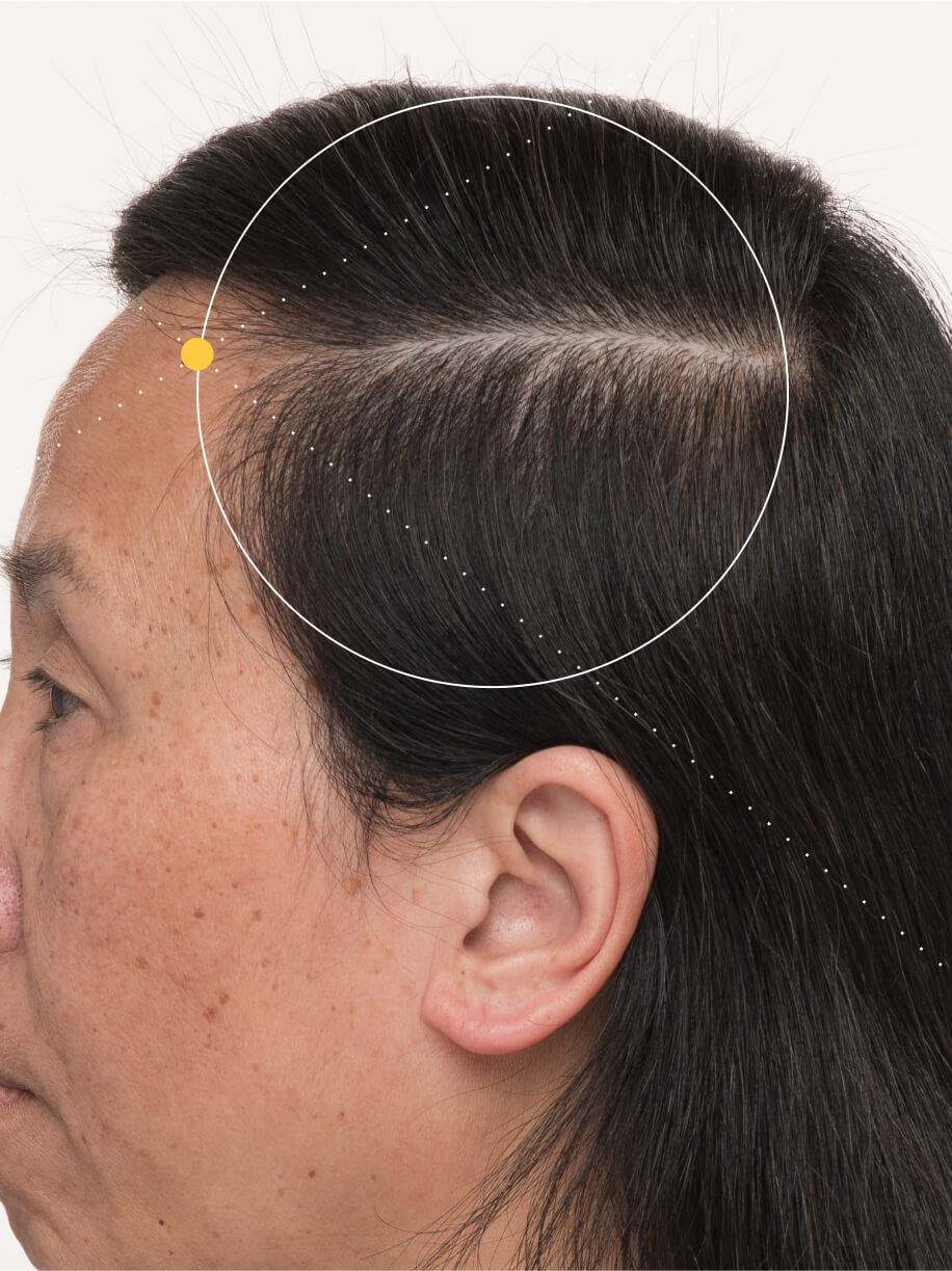 Heidi 6 months into taking Nutrafol Women Balance Hair Growth Nutraceutical. Results are from a clinical study and may vary