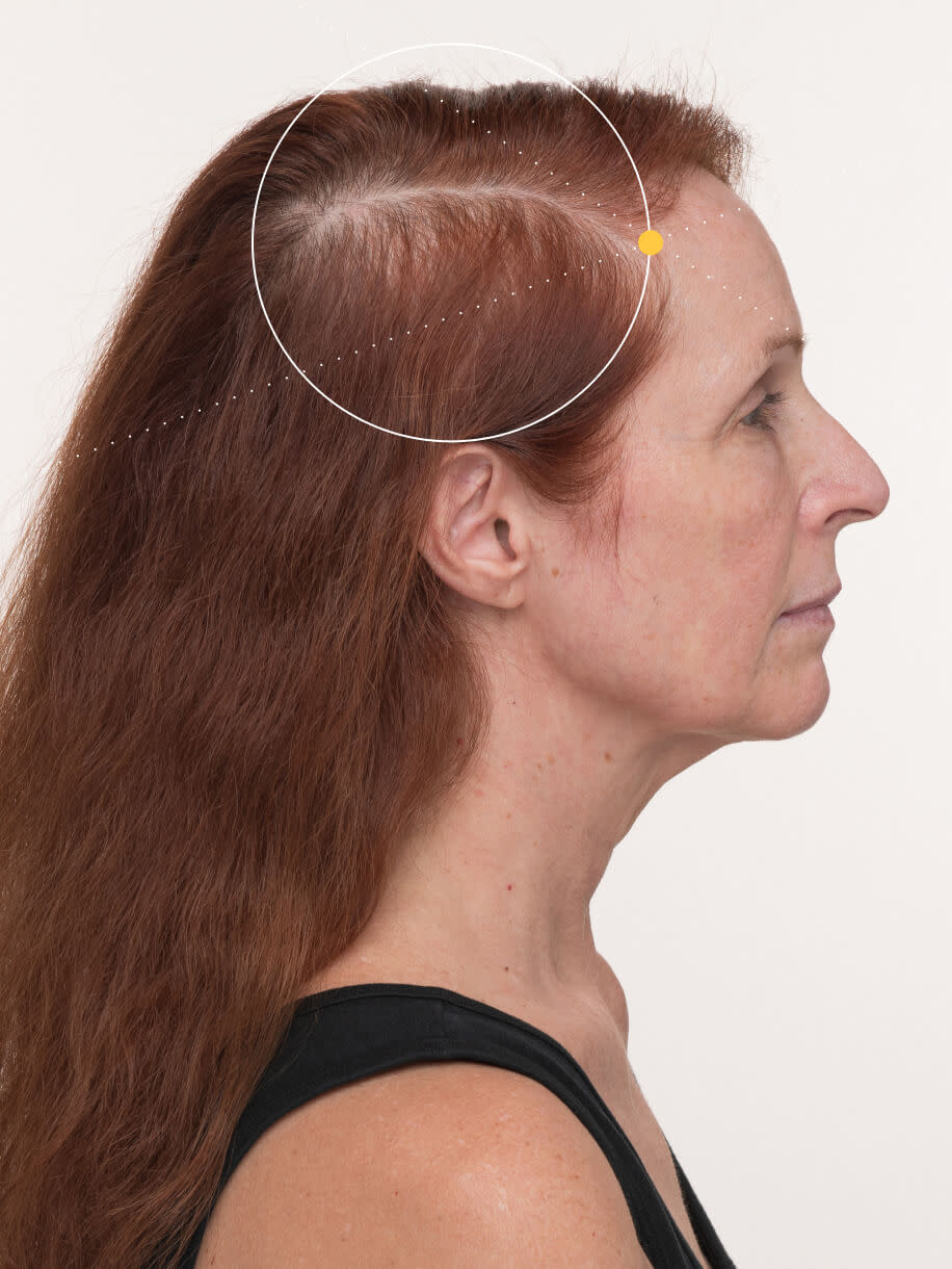 Lydia 3 months into taking Nutrafol Women’s Balance Hair Growth Nutraceutical. Results are from a clinical study and may vary