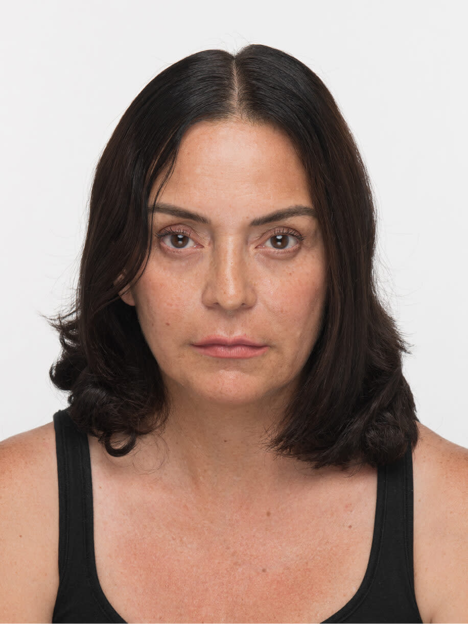 Elsie before taking Nutrafol Women’s Balance Hair Growth Nutraceutical.