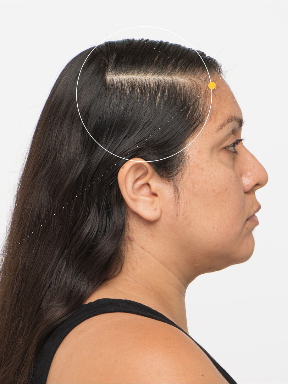 Kristy before taking Nutrafol Women Hair Growth Nutraceutical.