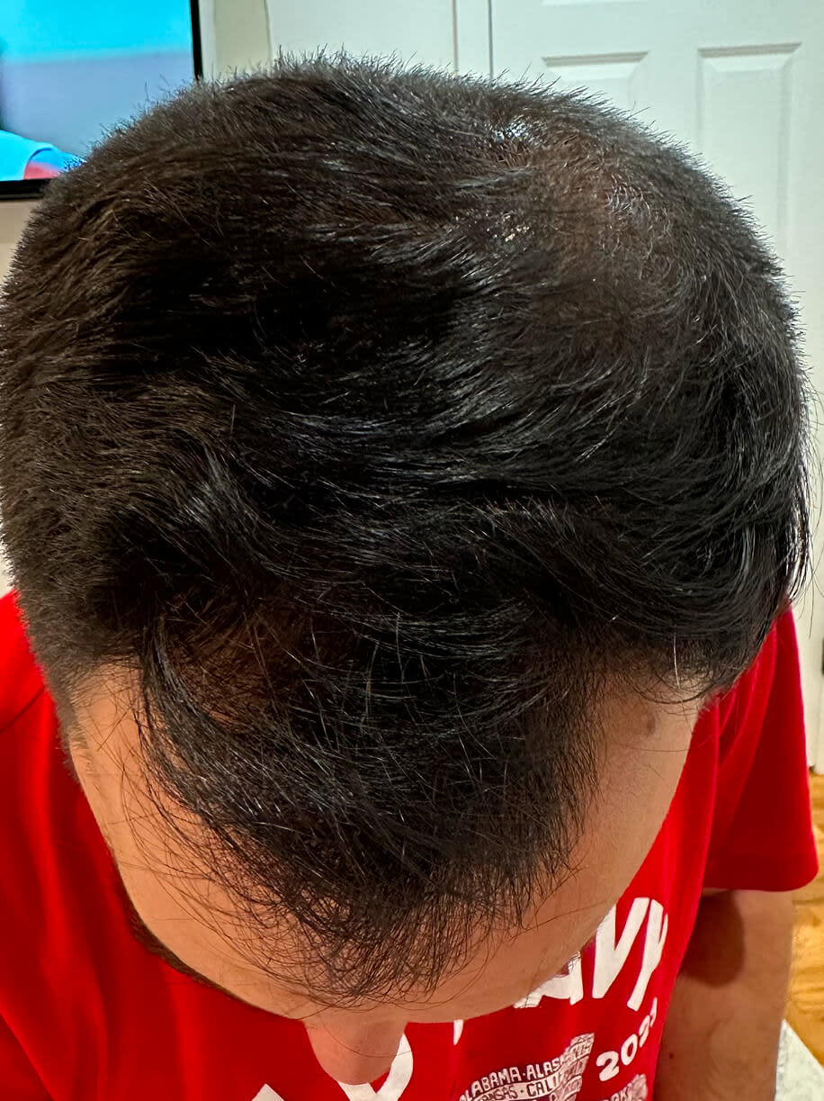 Michael 4 months into taking Nutrafol Men Hair Growth Nutraceutical. Results are from a clinical study and may vary