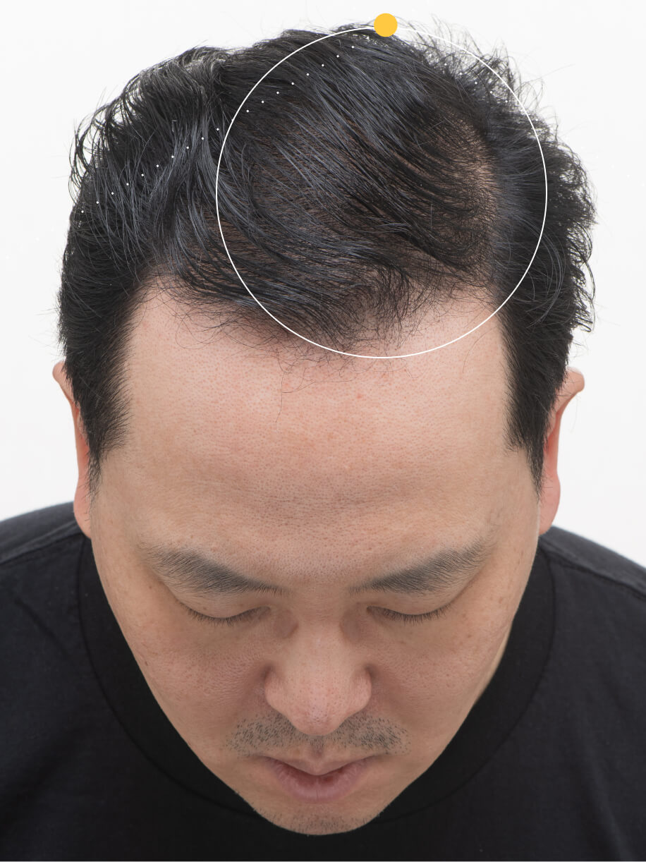 STEPHEN before taking Nutrafol Men 50+ Hair Growth Nutraceutical.