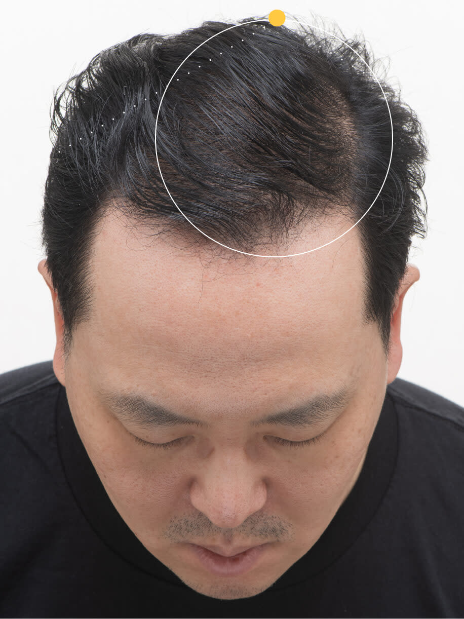 Stephen before taking nutrafol men 50+ hair growth nutraceutical.