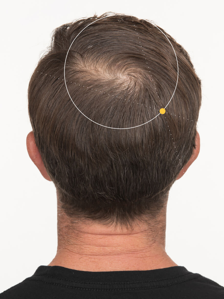 Mark before taking Nutrafol Men Hair Growth Nutraceutical.