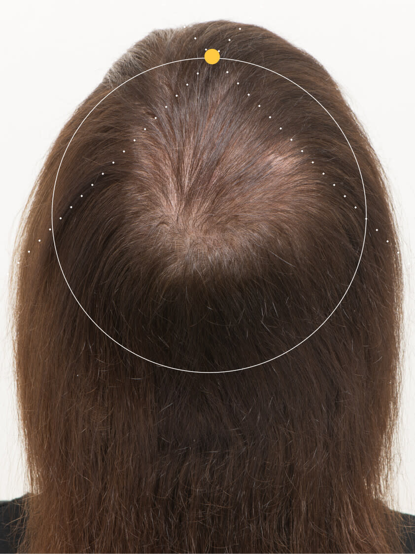 Robert 9 months into taking nutrafol men hair growth nutraceutical.