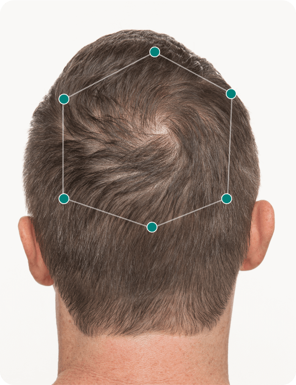 Jim before taking Nutrafol Men Hair Growth Nutraceutical.