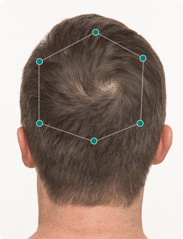 Jim 3 months taking Nutrafol Men Hair Growth Nutraceutical. Results may vary.