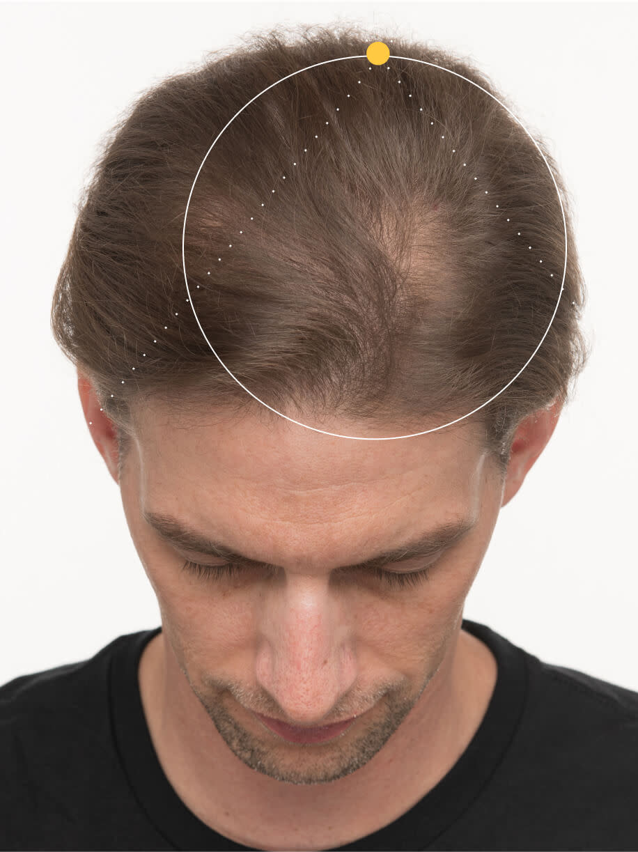 Sam before taking Nutrafol Men Hair Growth Nutraceutical.