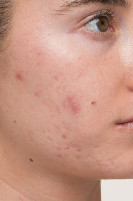 Lindsey before taking Nutrafol Clear Skin Nutraceutical.