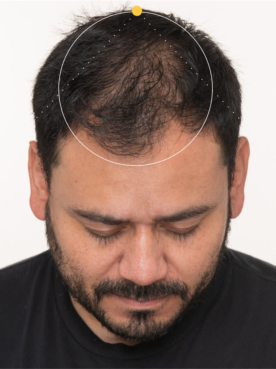Jose before taking Nutrafol Men Hair Growth Nutraceutical.
