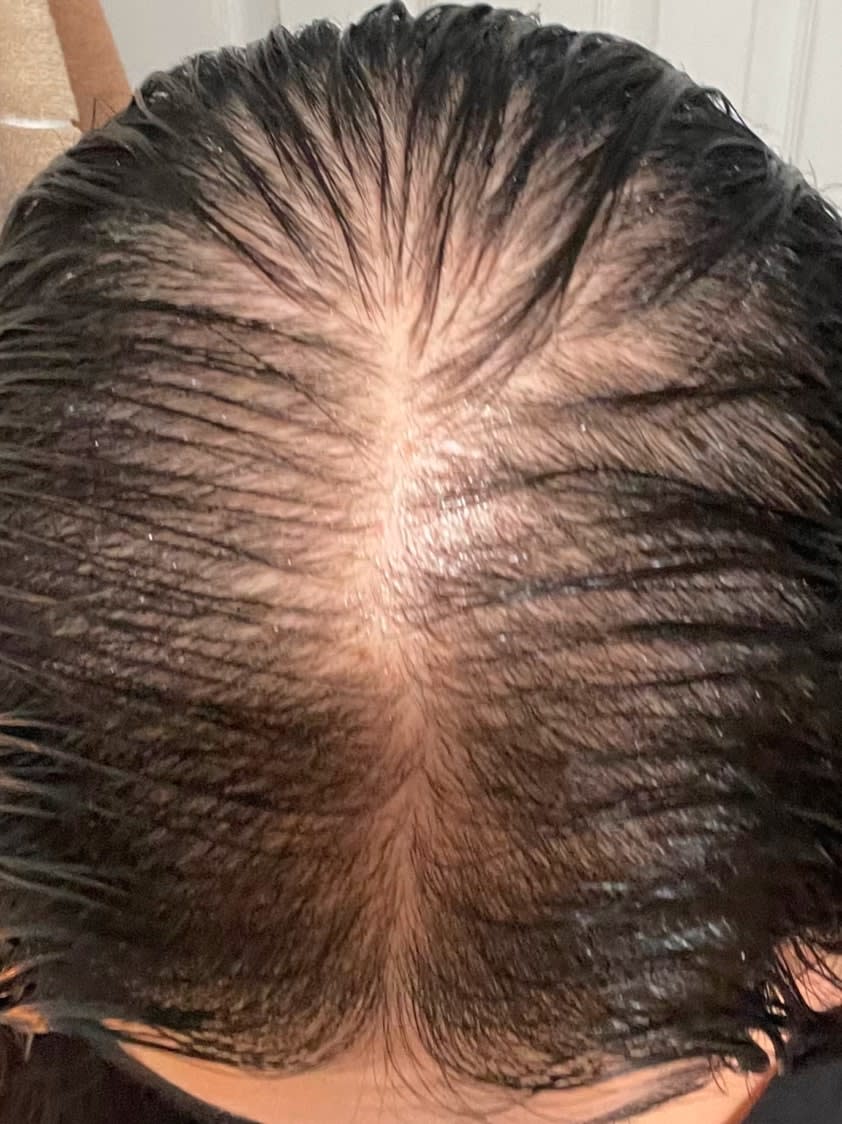 Melanie before taking Nutrafol Women’s Vegan Hair Growth Nutraceutical.