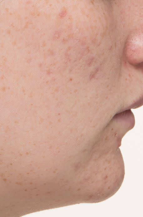 Emily after 12 weeks taking Nutrafol Clear Skin Nutraceutical.