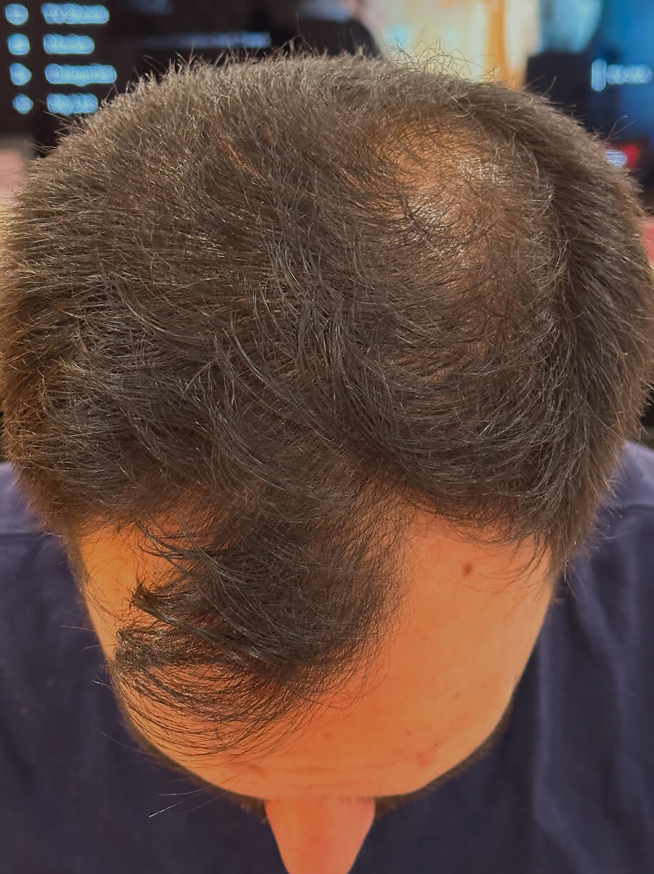 Michael before taking Nutrafol Men Hair Growth Nutraceutical.