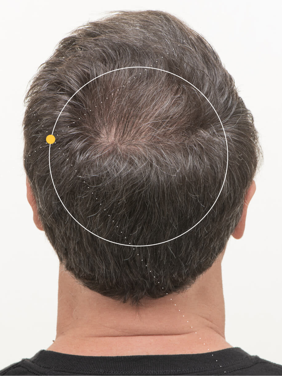 David 9 months into taking Nutrafol Men 50+ Hair Growth Nutraceutical. Results are from a clinical study and may vary