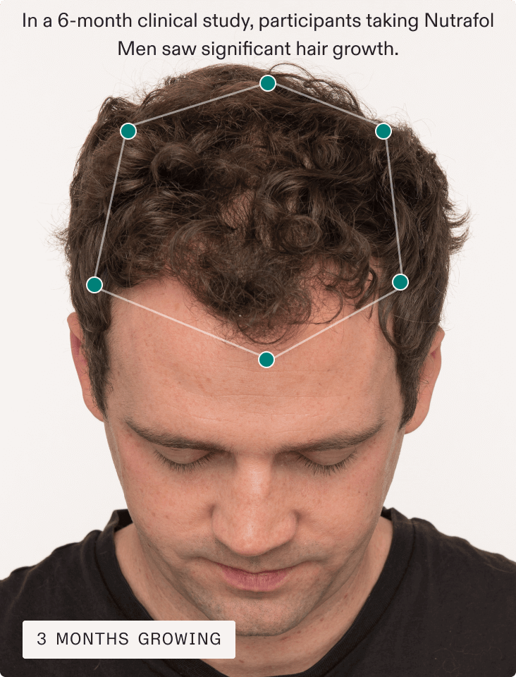 Man's hair 3 months growing with Men Hair Growth Nutraceutical. Results may vary