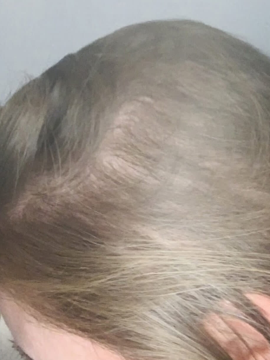 Crystal 4 months into taking Nutrafol Women Hair Growth Nutraceutical. Results are from a clinical study and may vary