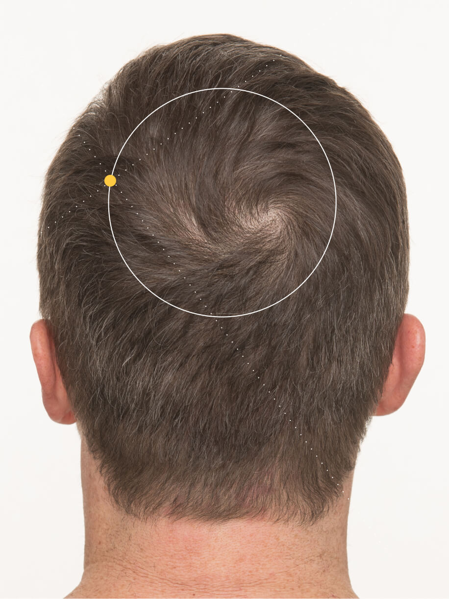 Jim 4 months into taking Nutrafol Men Hair Growth Nutraceutical. Results are from a clinical study and may vary