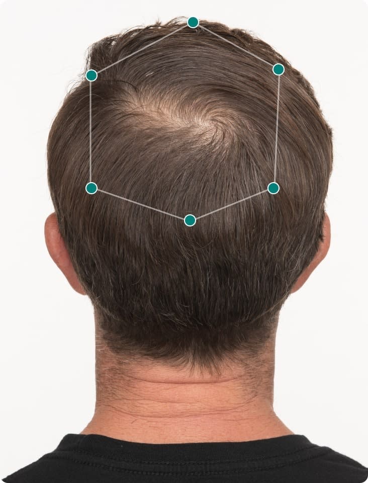 Mark's scalp before taking Nutrafol.