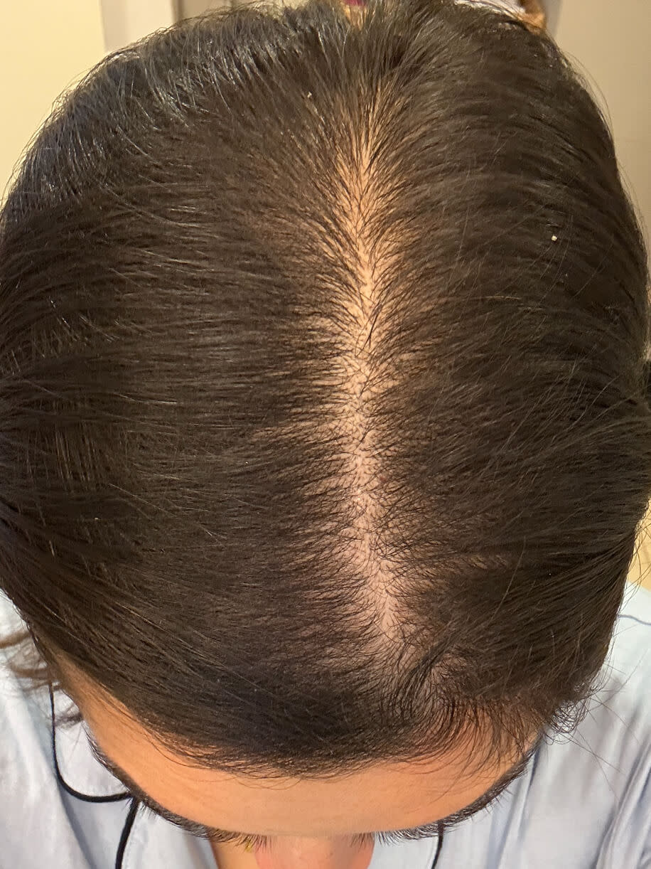 Antonella 3 months into taking Nutrafol Women’s Postpartum Hair Growth Nutraceutical. Results are from a clinical study and may vary