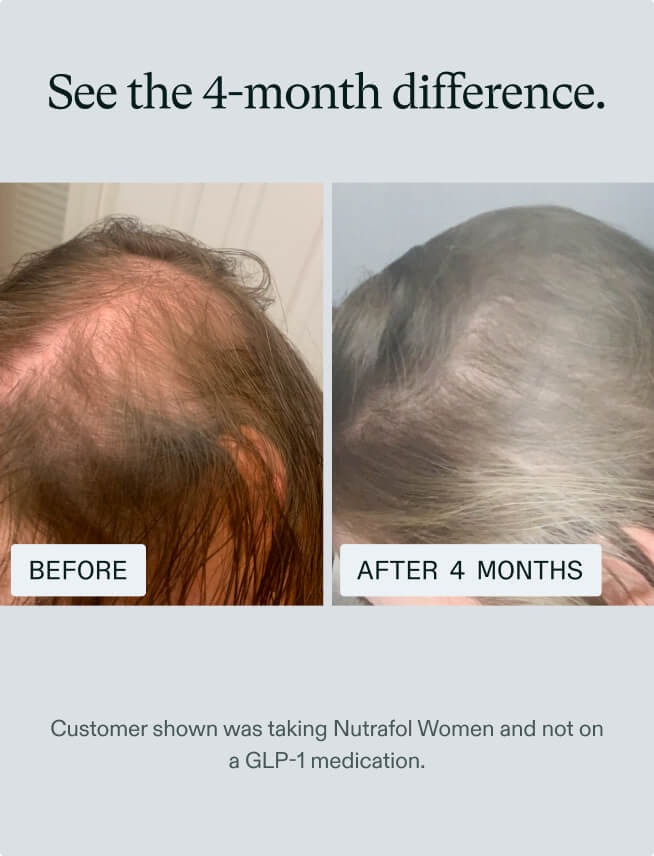 GLP-1 Hair Thinning? Support Growth with Nutrafol