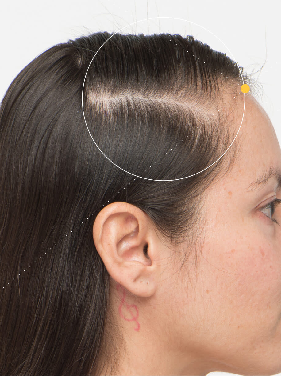 Alejandra before taking Nutrafol Women Hair Growth Nutraceutical.