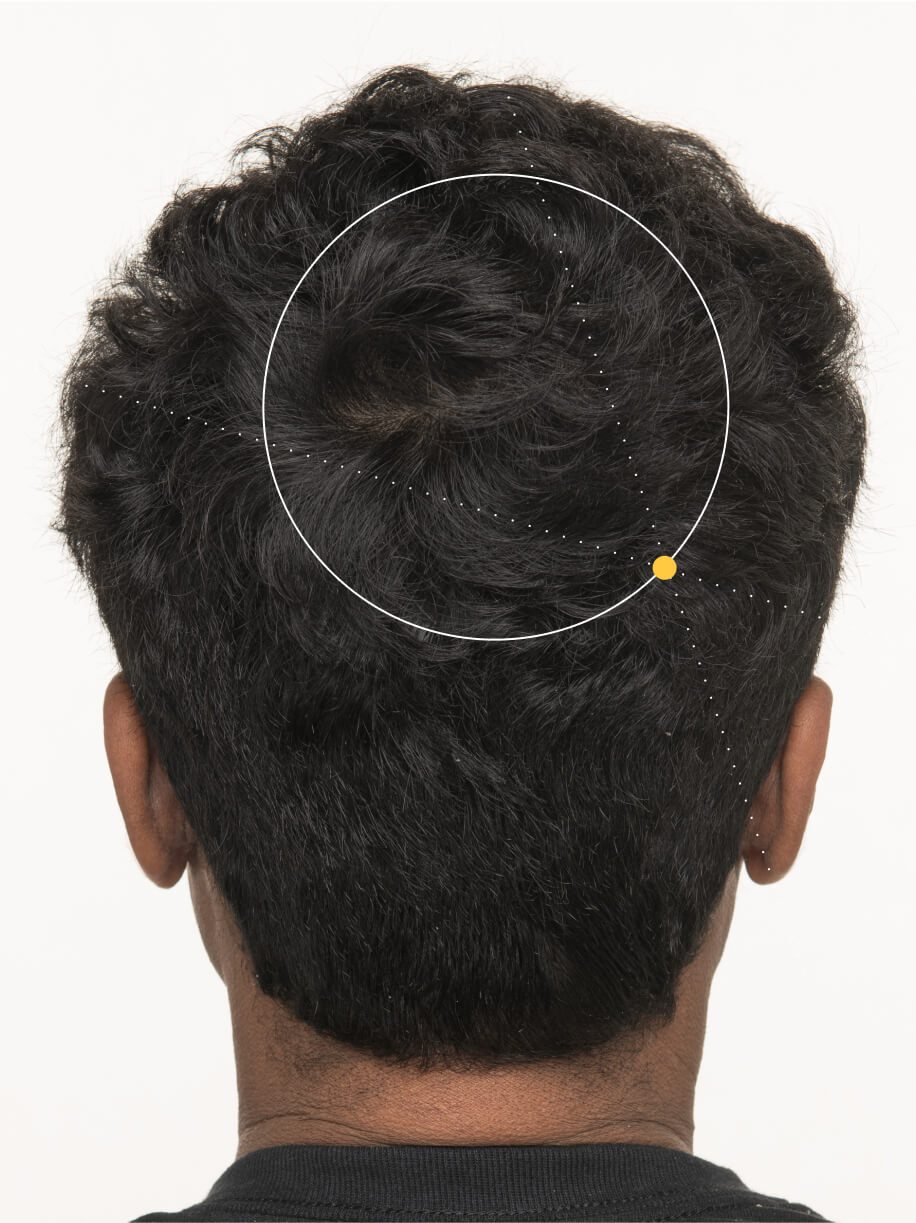 Anuradha 3 months into taking Nutrafol Men Hair Growth Nutraceutical. Results are from a clinical study and may vary