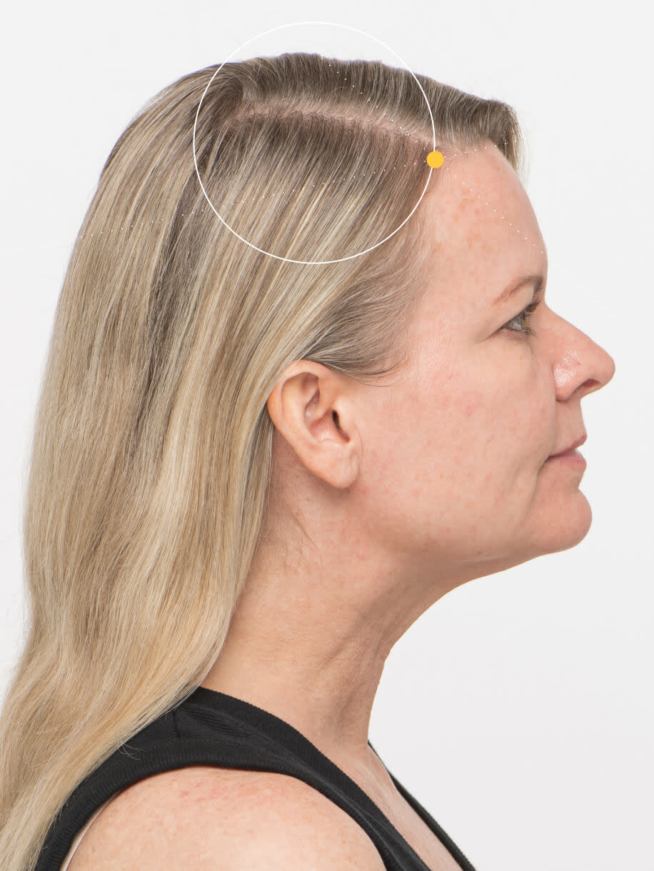 Naomi 3 months into taking Nutrafol Women’s Vegan Hair Growth Nutraceutical. Results are from a clinical study and may vary