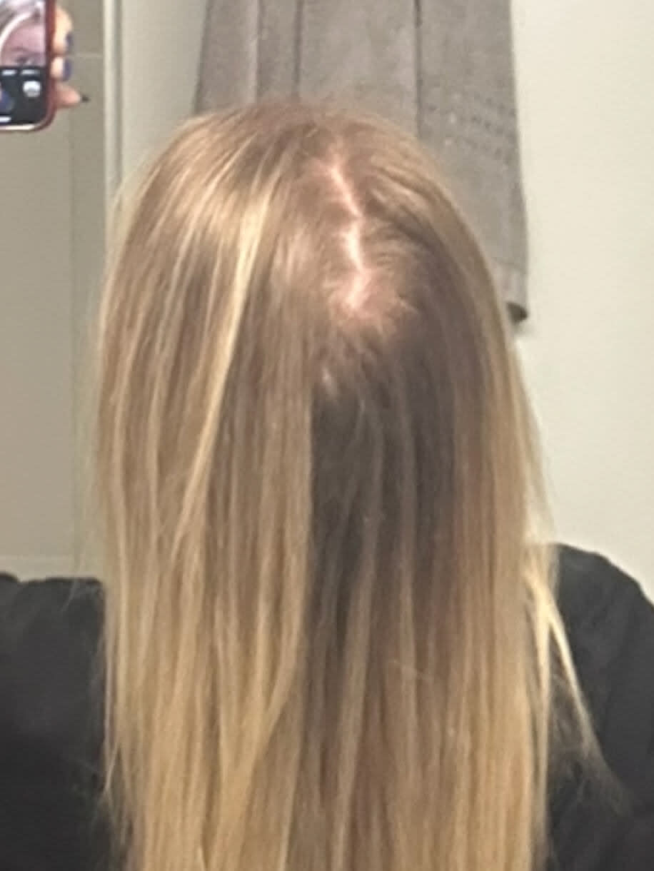 Jamie before taking Nutrafol Women Hair Growth Nutraceutical.