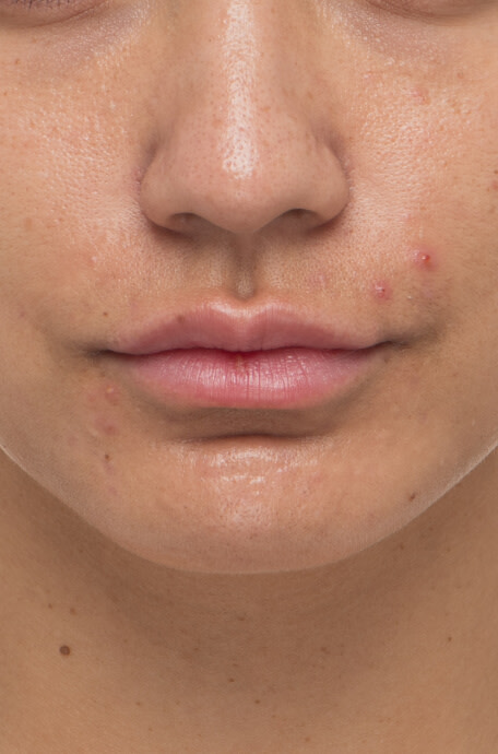 Casey before taking Nutrafol Clear Skin Nutraceutical.