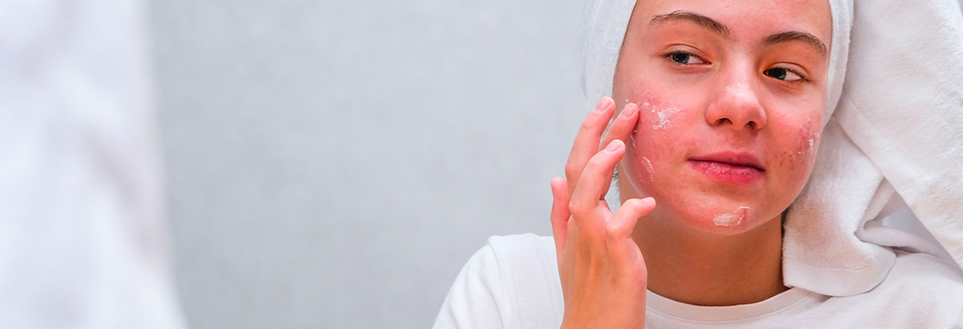 ¡Todo lo que necesitas saber sobre el acné! – Pomys