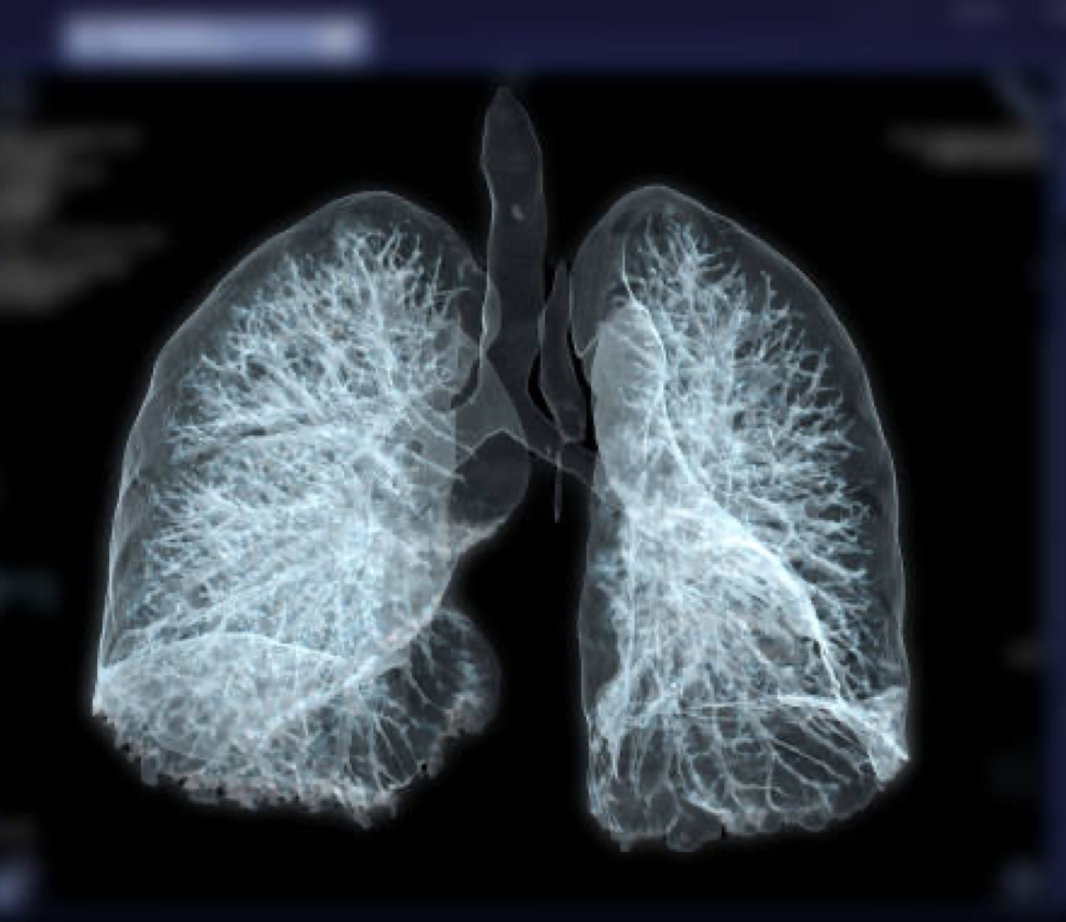 Pulmonary Hypertension Image