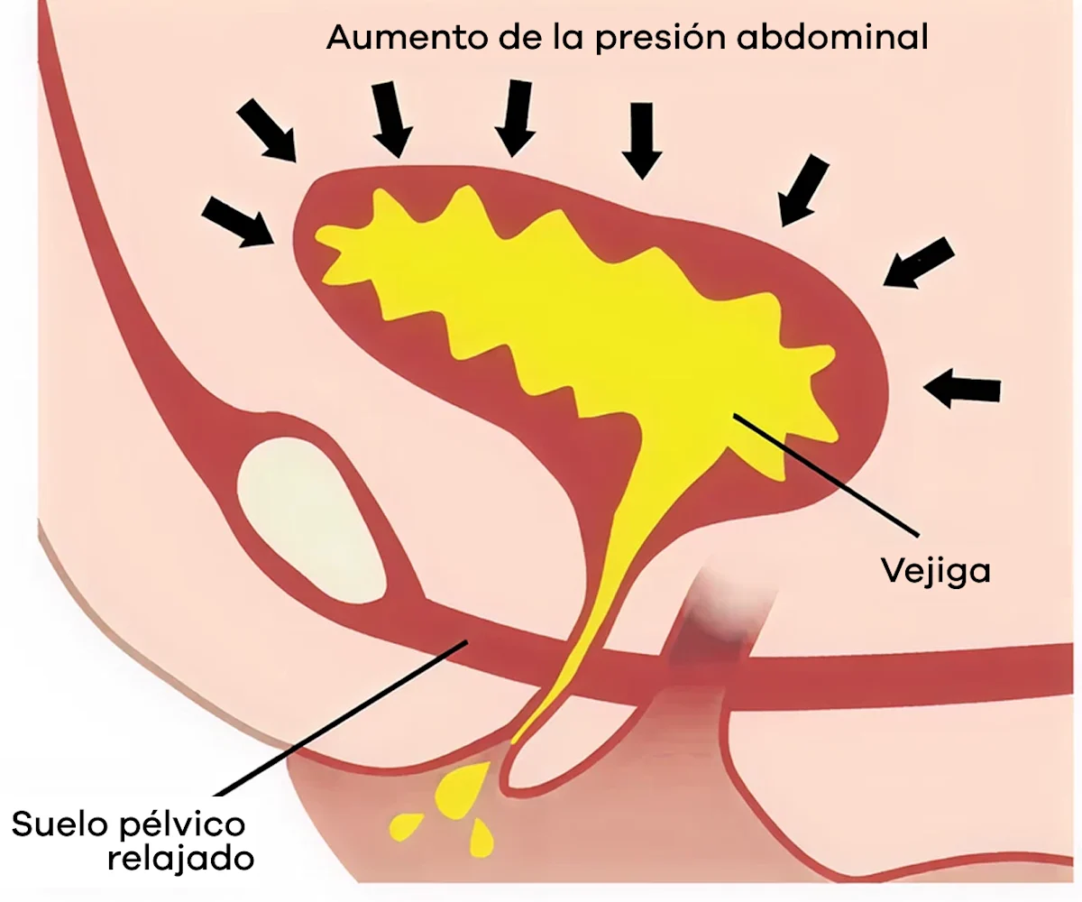 Aumento de la presión abdominal sobre la vejiga en la incontinencia de esfuerzo