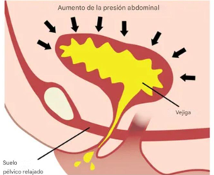 Aumento de la presión abdominal sobre la vejiga en la incontinencia de esfuerzo