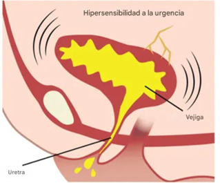 Vejiga hiperactiva y hipersensibilidad a la urgencia de orinar