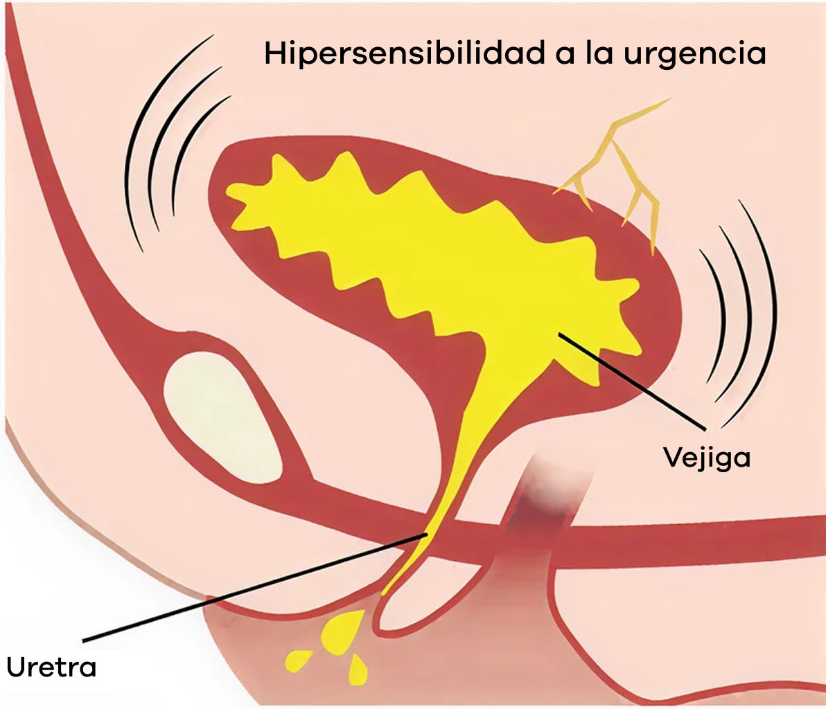 Vejiga hiperactiva y hipersensibilidad a la urgencia de orinar