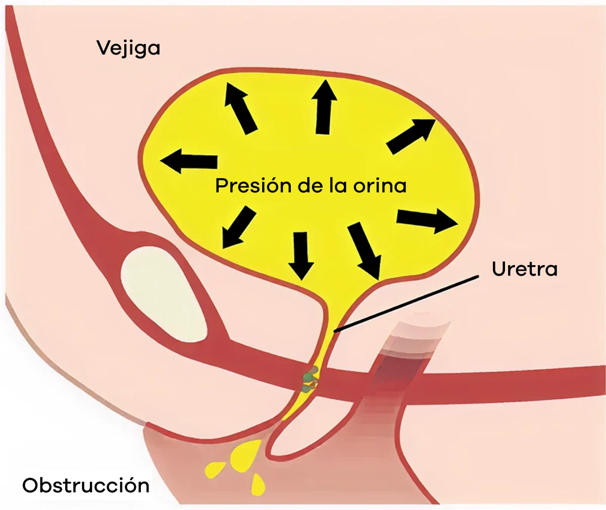 Presión de la orina en la incontinencia por rebosamiento Presión de la orina en la incontinencia por rebosamiento