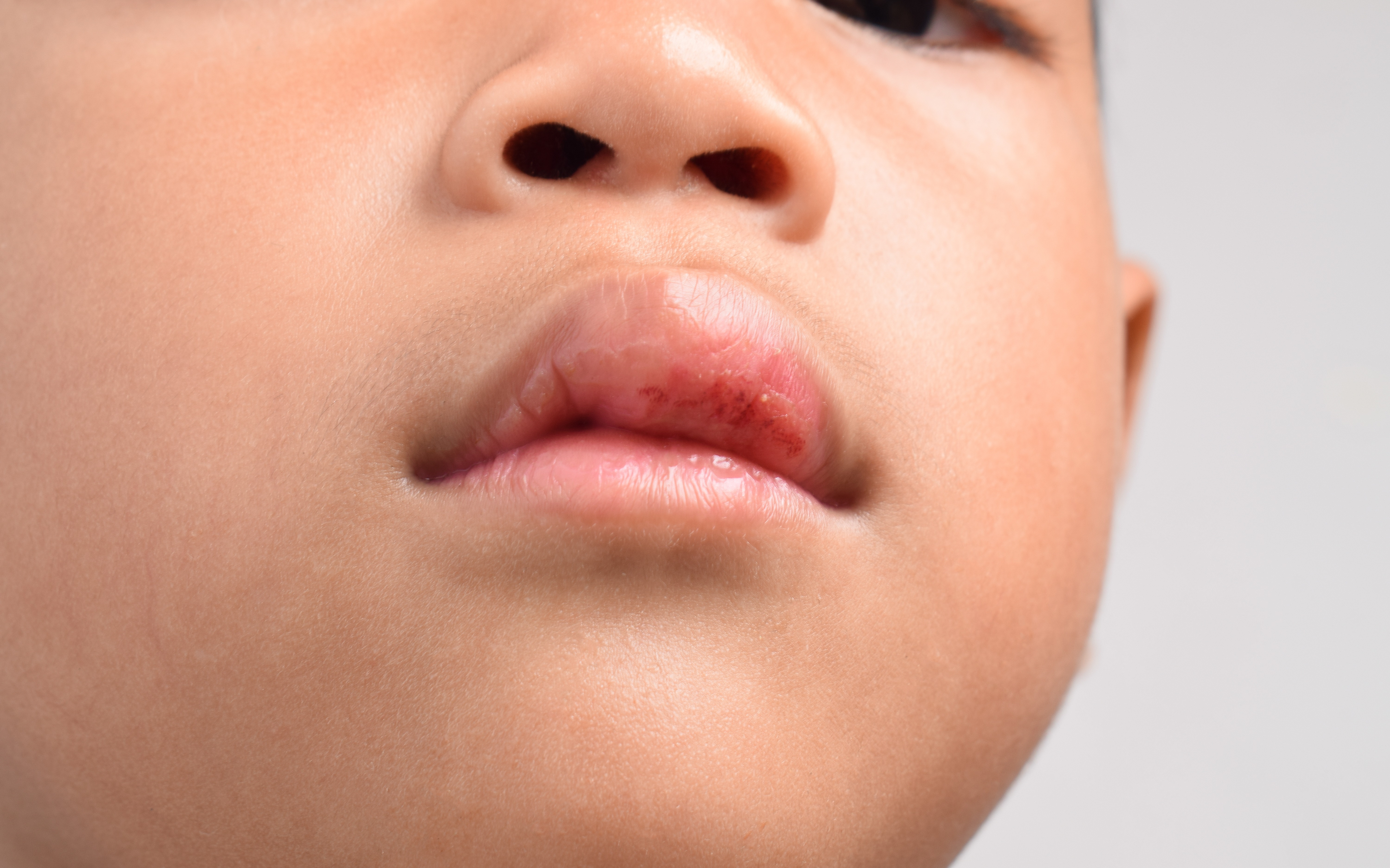 Allergie aux lvres : causes et symptmes - Aroma-Zone