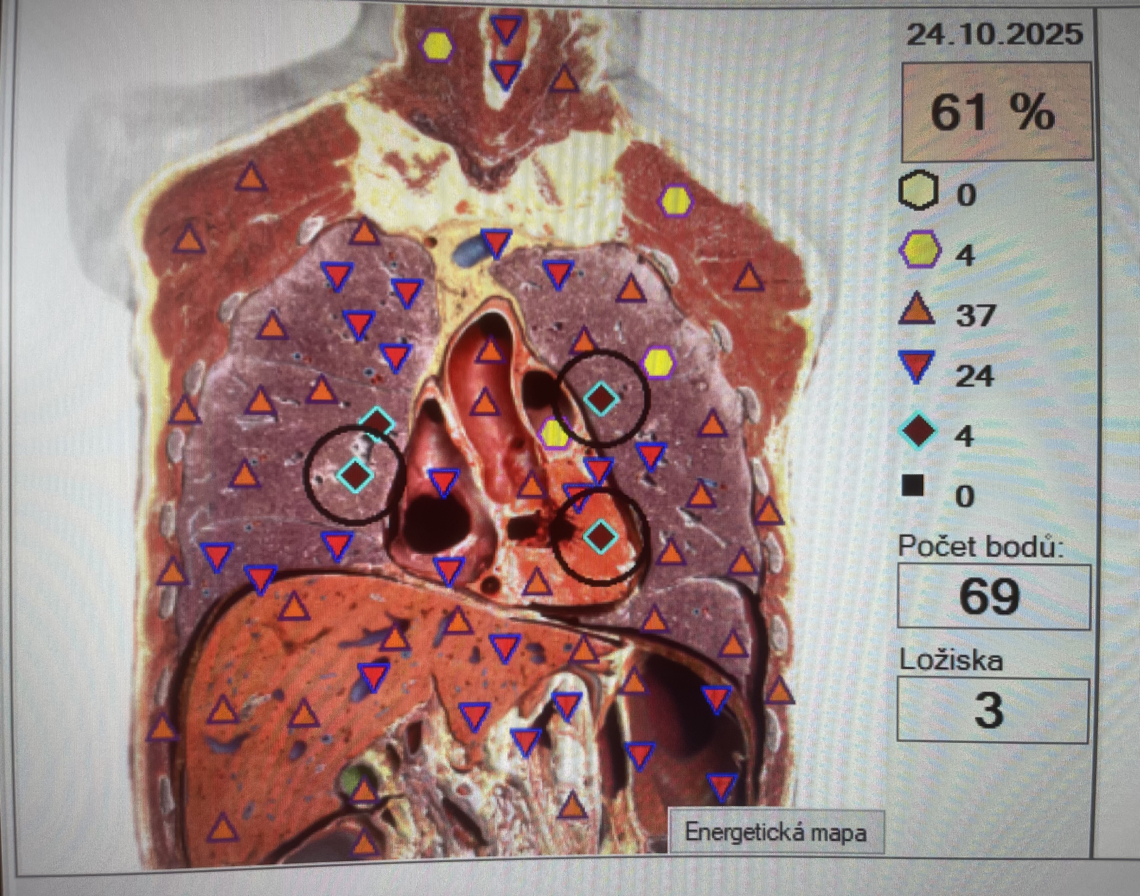 Řez hrudníkem před 