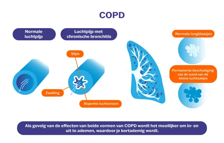 COPD rokerslong