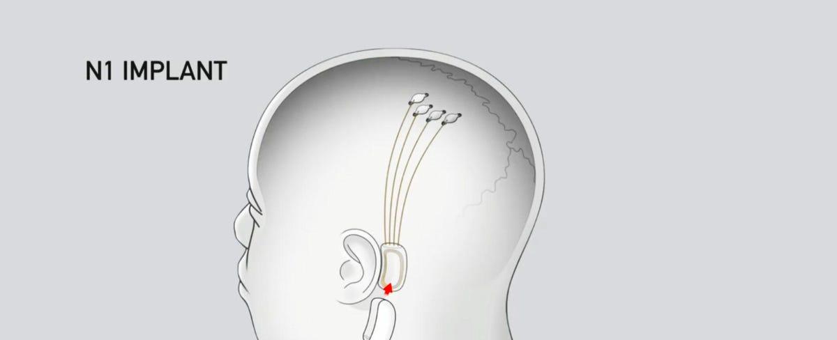 Elon Musk says an 'awesome' Neuralink update is coming soon