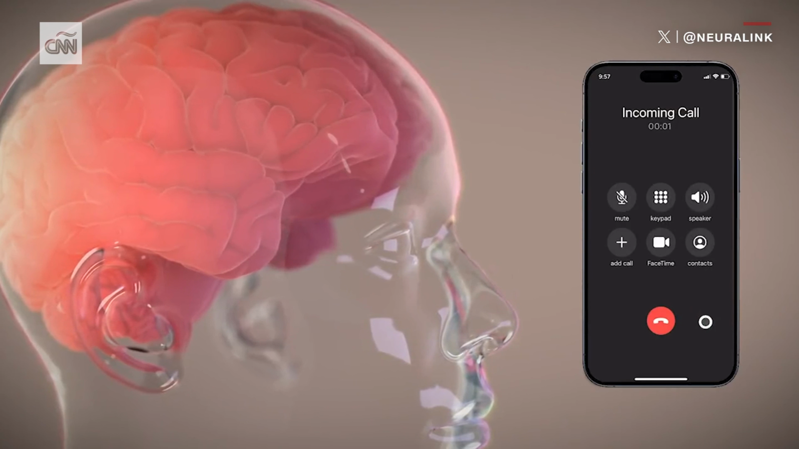 Elon Musk dice que el primer sujeto del ensayo en humanos de Neuralink puede controlar un mouse de computadora con un implante cerebral