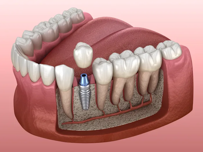 Doenças das Gengivas antes dos Implantes Dentários