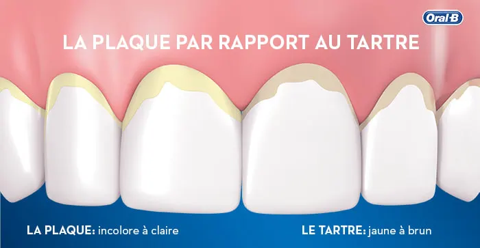 Que sont la plaque dentaire et le tartre et comment s’en débarrasser ?