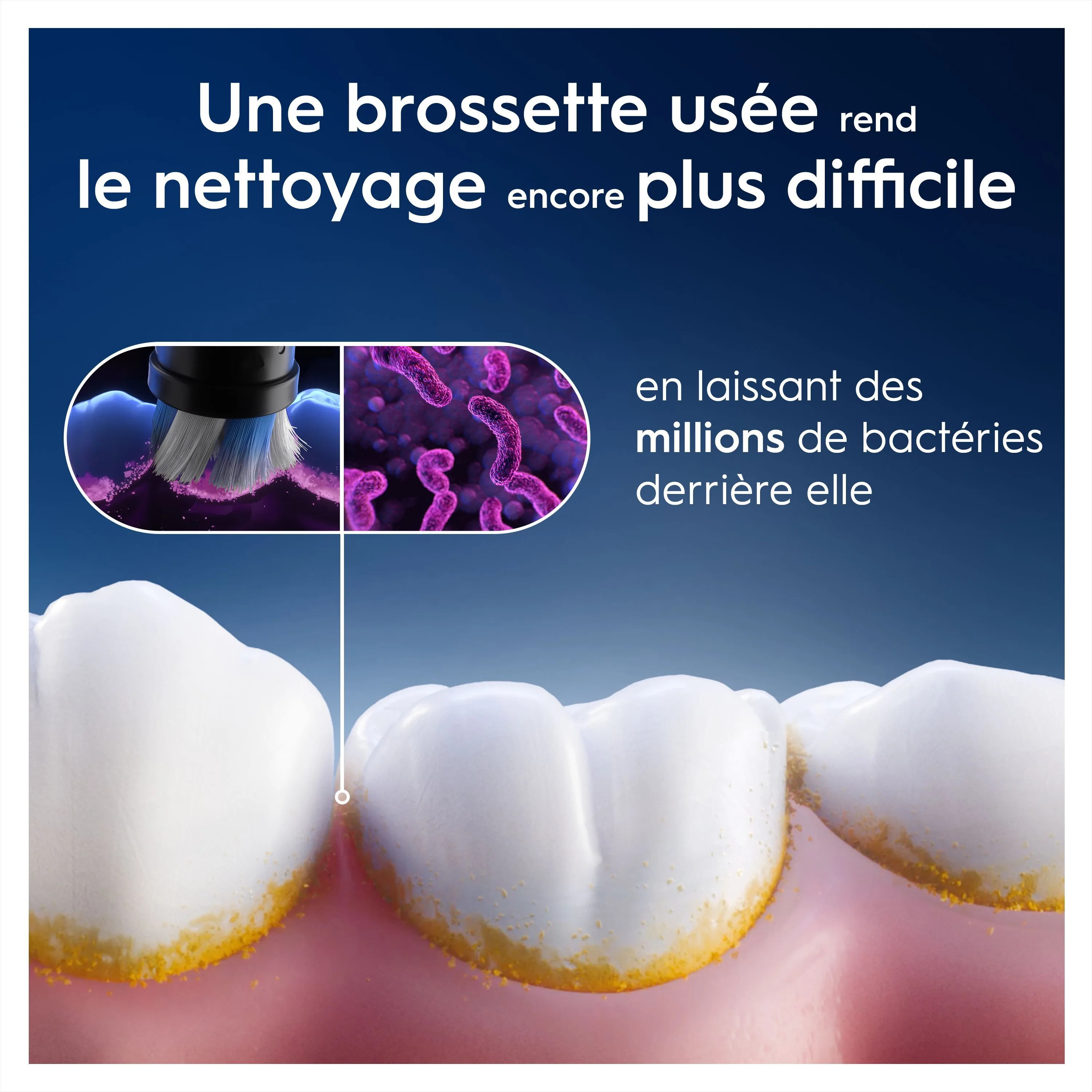 Une brosse à dents usagée laisse des millions de bactéries, rendant le nettoyage plus difficile, comme le montre la plaque dentaire.